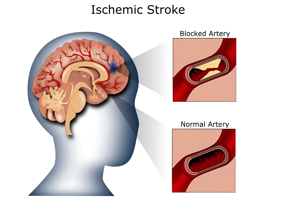 Cục máu đông khiến mạch máu thuyên tắc gây nên thiếu máu não
