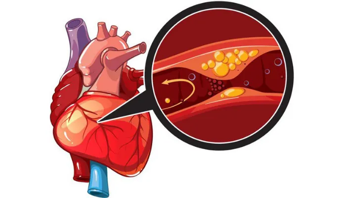 Nhồi máu cơ tim: Nguyên nhân, dấu hiệu, cách sơ cứu và phòng ngừa hiệu quả
