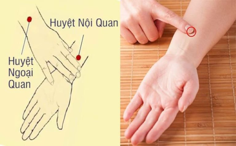 Huyệt nội quan và ngoại quan hạn chế nôn mửa và nấc