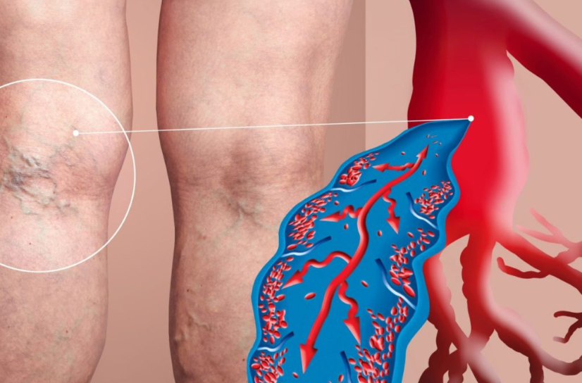 Huyết khối tĩnh mạch trở thành bệnh lý phổ biến hiện nay