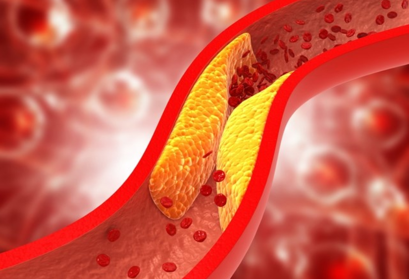 Điều trị rối loạn lipid máu ở người tiểu đường mang đến nhiều lợi ích