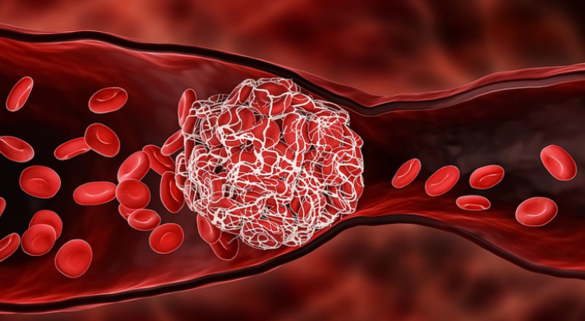 Thuốc đột quỵ được sử dụng phổ biến để phòng ngừa