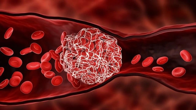 NattoEnzym 1000 trong việc ngăn ngừa máu đông chống đột quỵ - Cục máu đông thường xuất hiện khi cơ thể bị thương