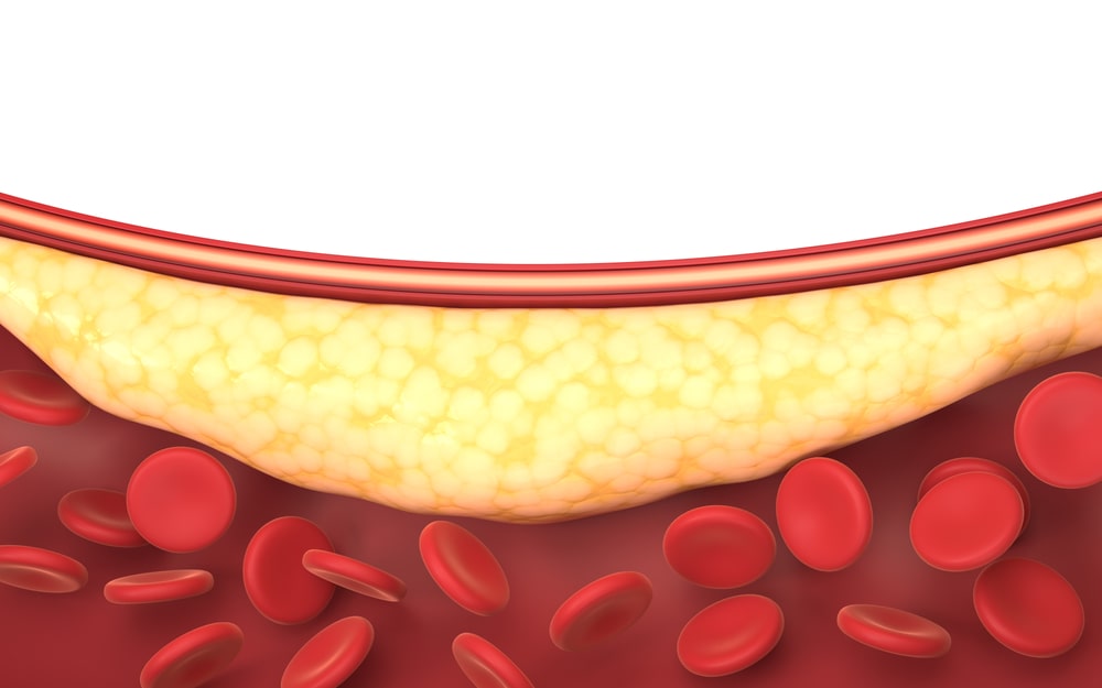 Mỡ máu có nguy cơ gây nên đột quỵ - Men gạo đỏ và Nattokinase hỗ trợ giảm cholesterol hiệu quả