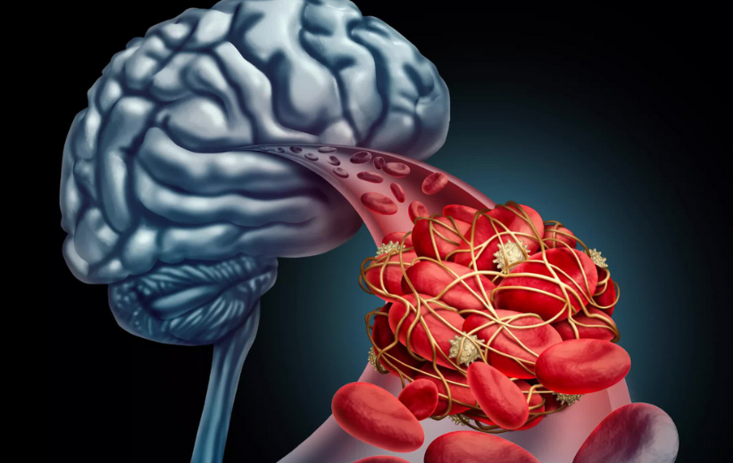 Cục máu đông trong não là tình trạng nguy hiểm đến tính mạng
